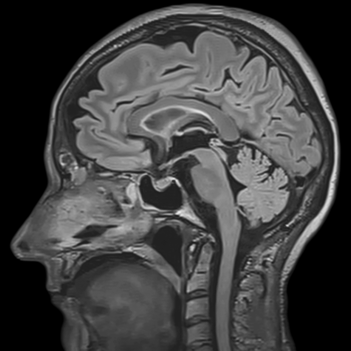 brain mri